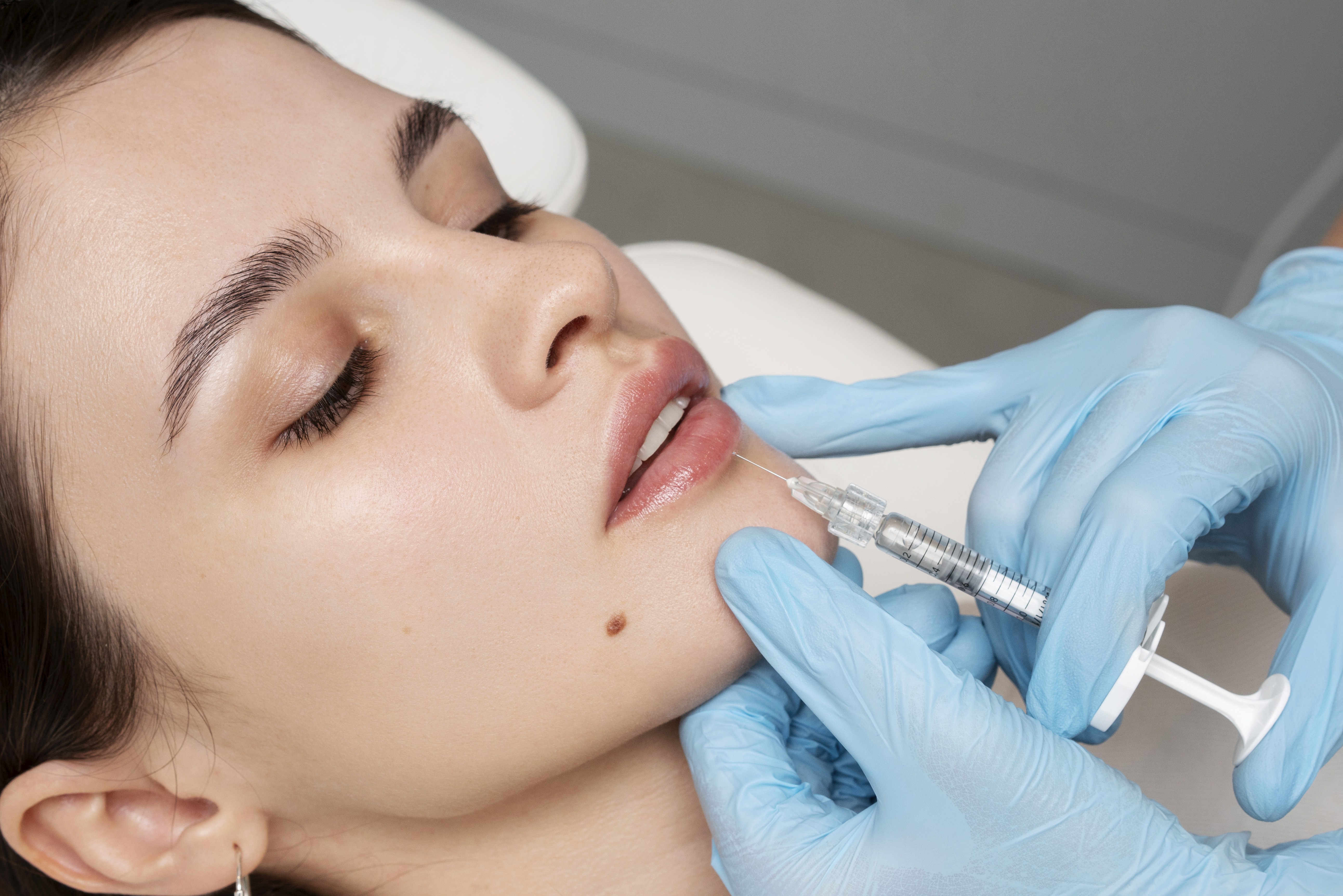 Lip Lift en Terrasa, Heaven Clinics
