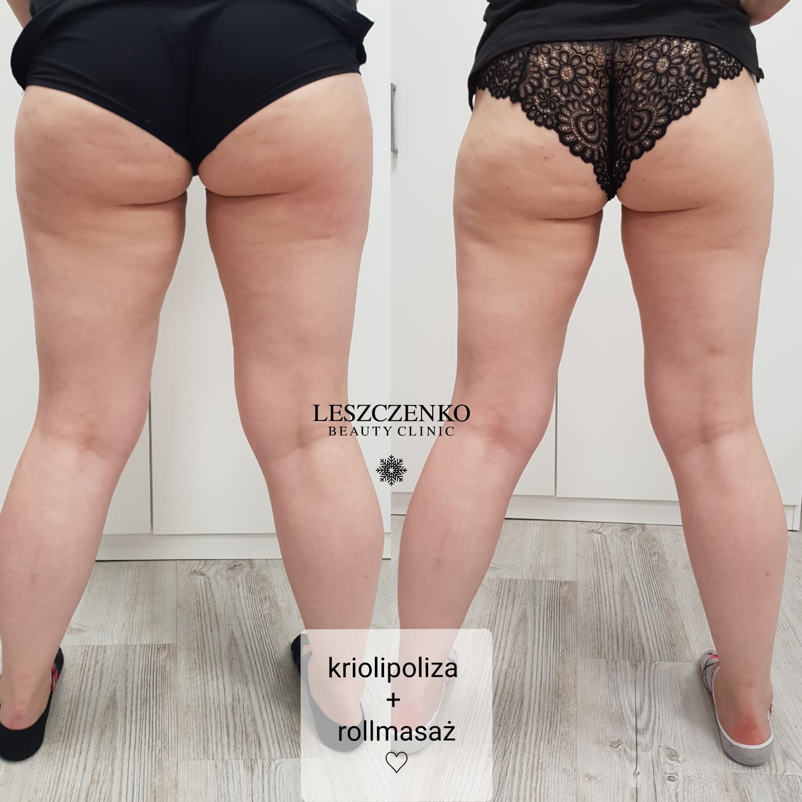 Kriolipoliza kontrastowa_szczecin