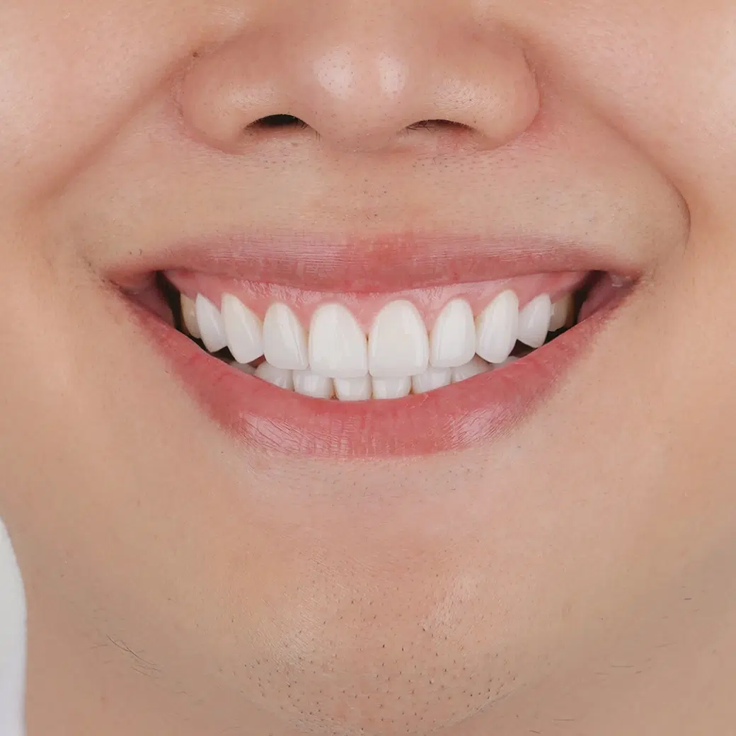 Beam of Beauty Laser at COSDENT Smile Design in Bangkok