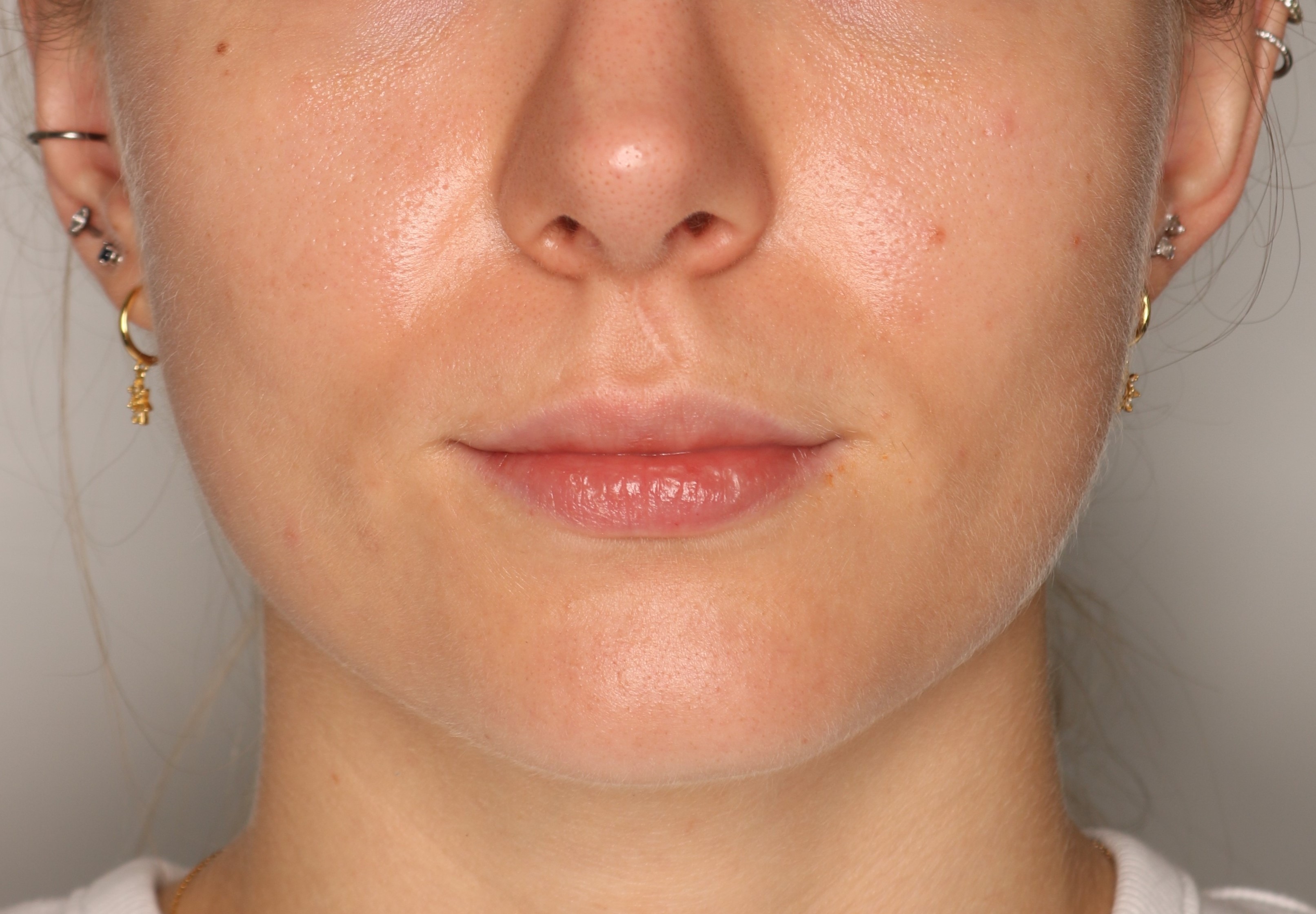 Efekt zabiegu toksyna botulinowa - Po 3