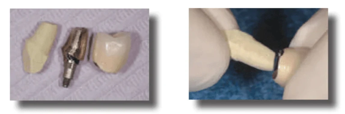 Cement Overflow: The Number One Biological Complication in Implant Dentistry | Bloor-Yorkville Periodontics