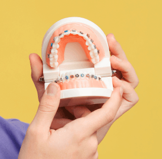 Modell mit klassischer Zahnspange – feste Brackets in farbiger Ausführung für Kinder.