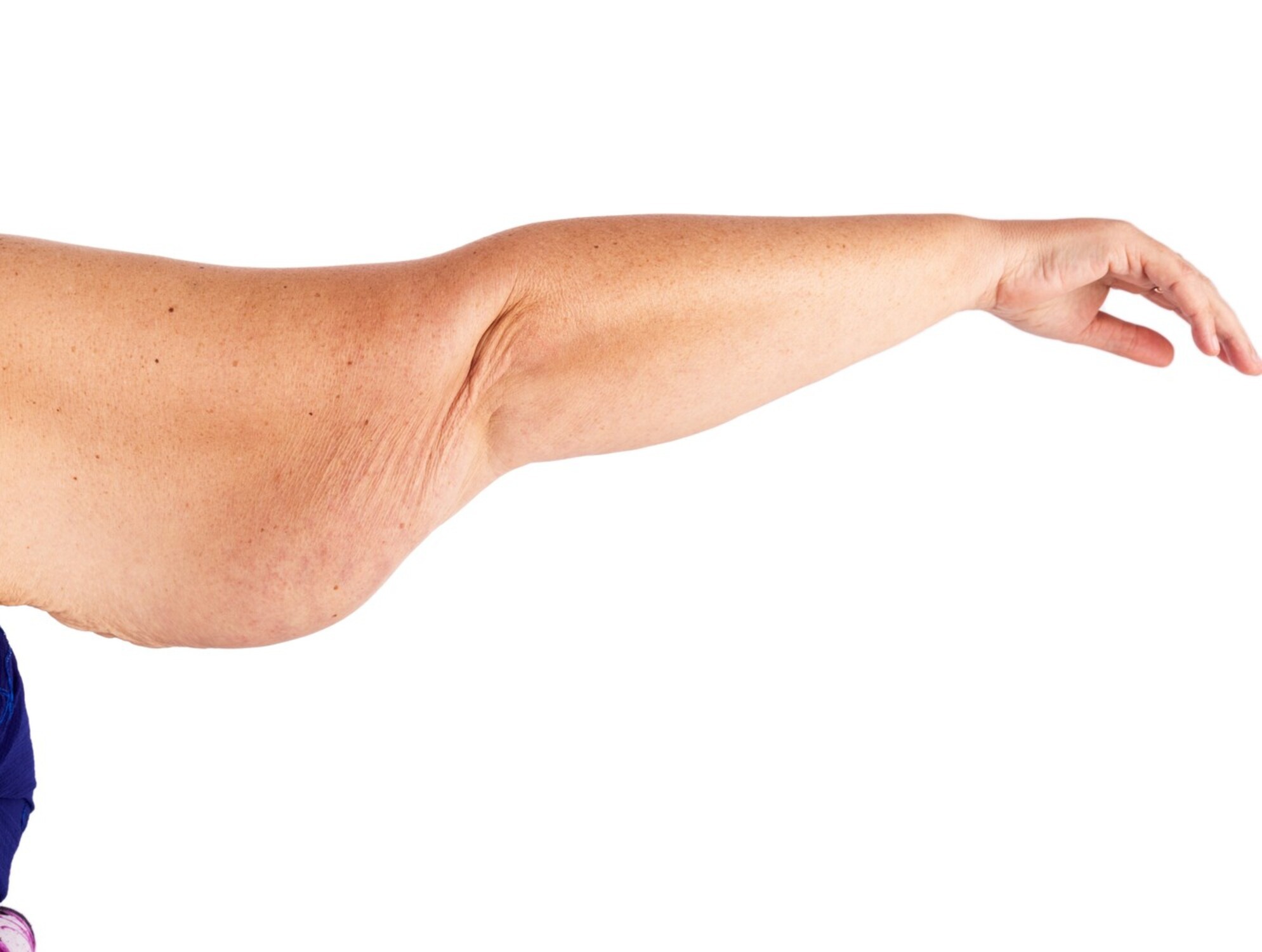 tighten skin after weight loss