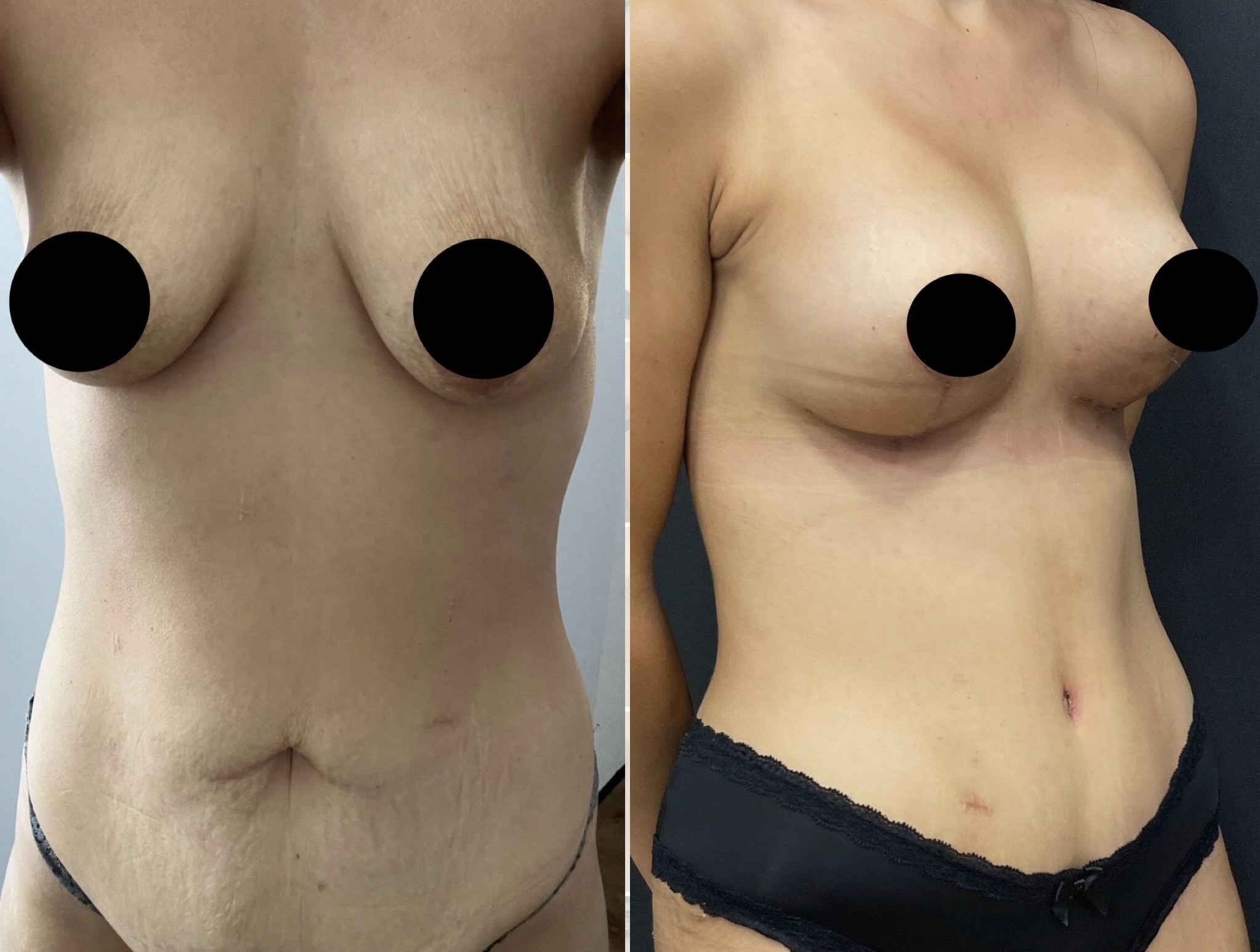 breast lift with implants and tummy tuck (mommy makeover) before after oblique view