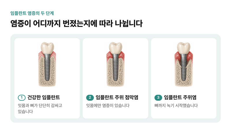 건강한 임플란트, 잇몸에만 염증이 있는 임플란트 주위 점막염, 뼈까지 내려간 임플란트 주위염을 같은 단면으로 비교한 일러스트