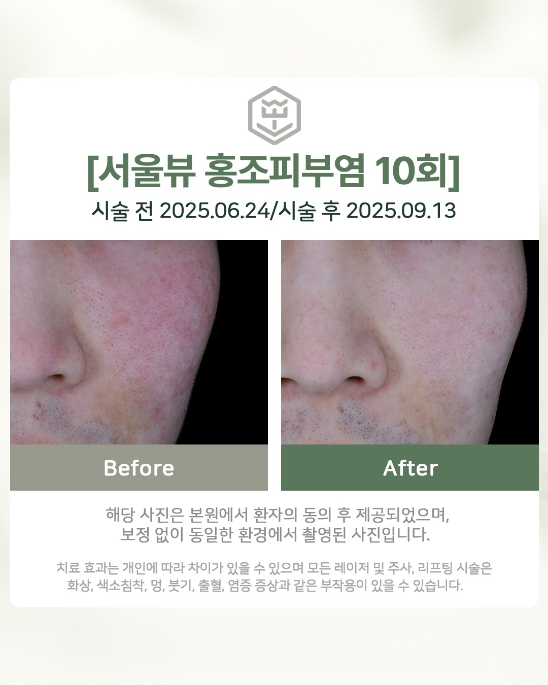 홍조피부염 10회