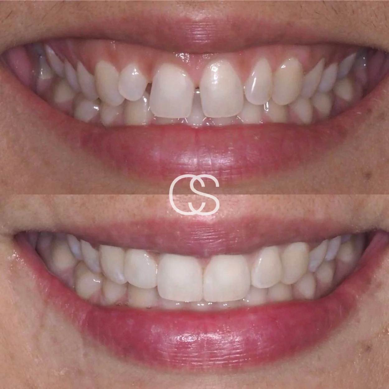 Before & After Crowns, Colac Smiles