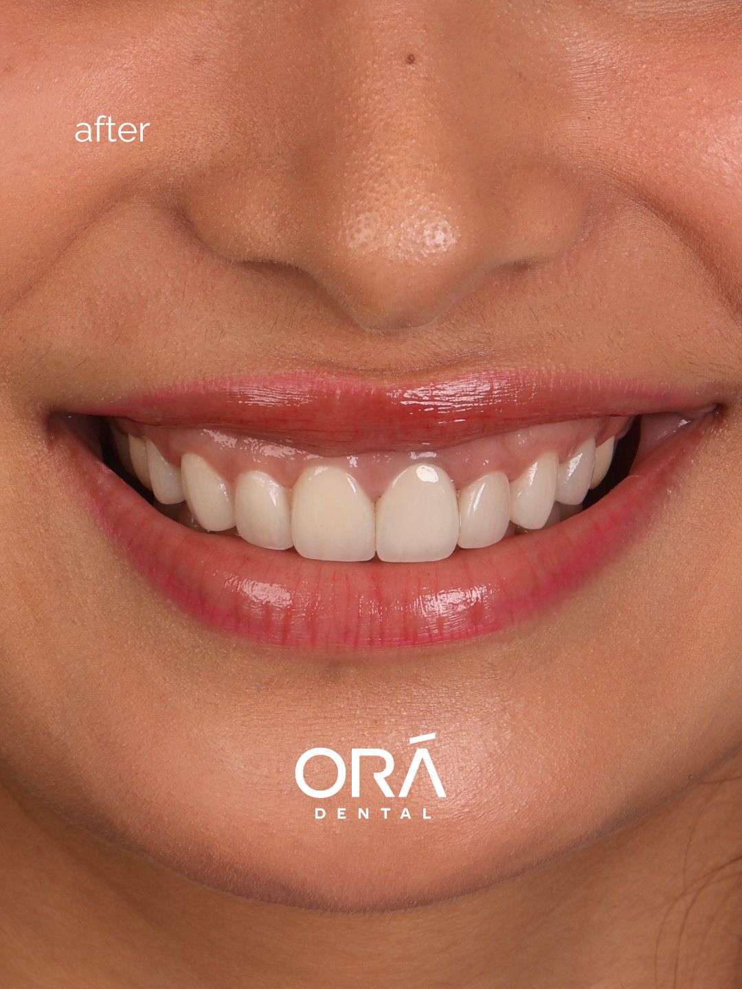 Close-up after photo showing proportionate natural EMax veneer results for Miss Universe Philippines 2025 finalist at Ora Dental Makati