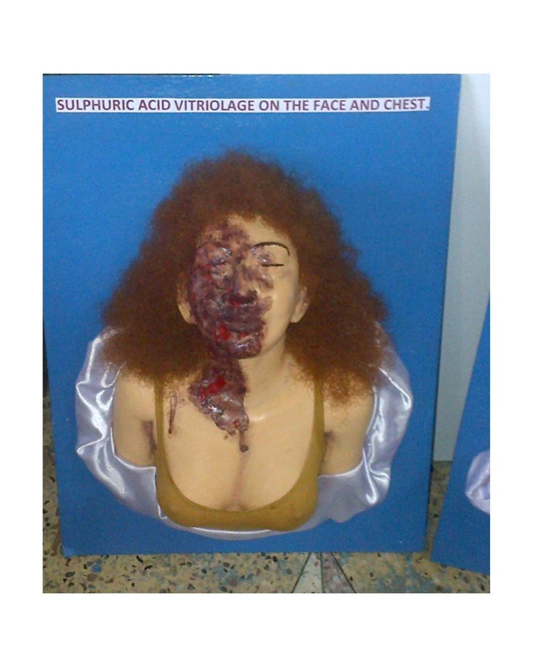 Sulphuric Acid Vitriolage on Face & Chest