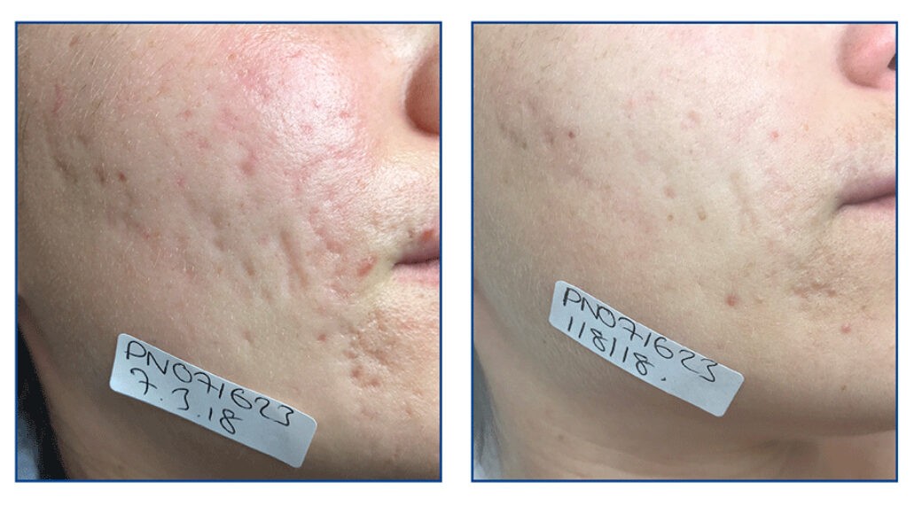 Laser treatment on woman's cheek with protective eye shield