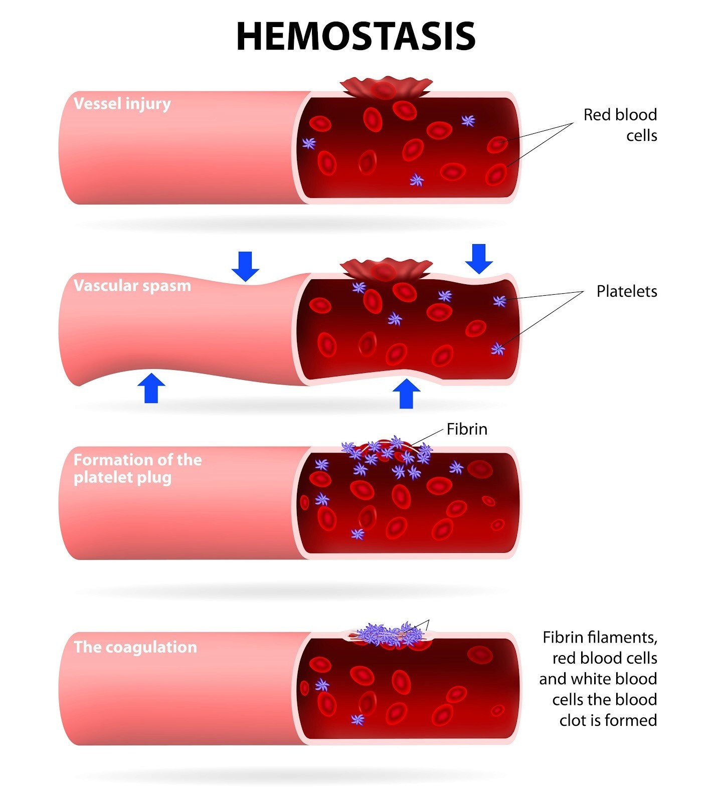 blood clot formation, AI generated