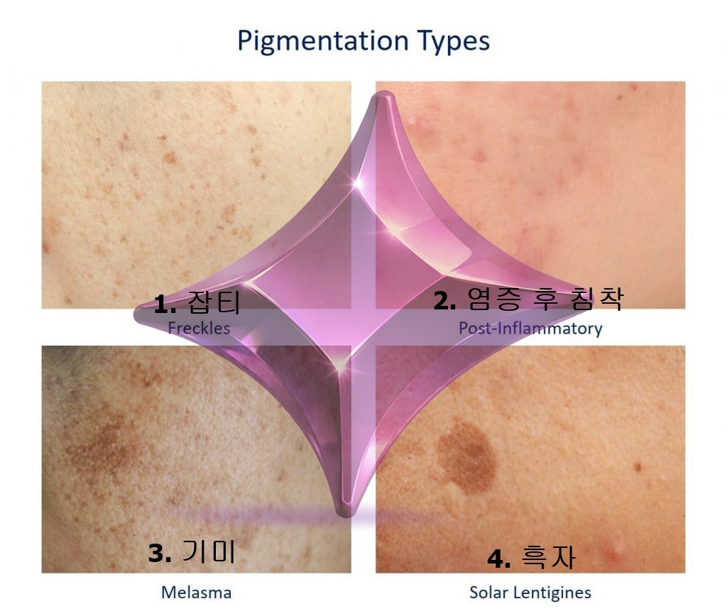 뷰티스톤의원 색소분류