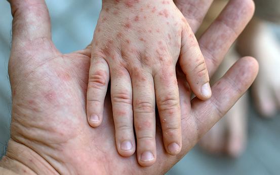Рука дитини, уражена вірусом Коксакі