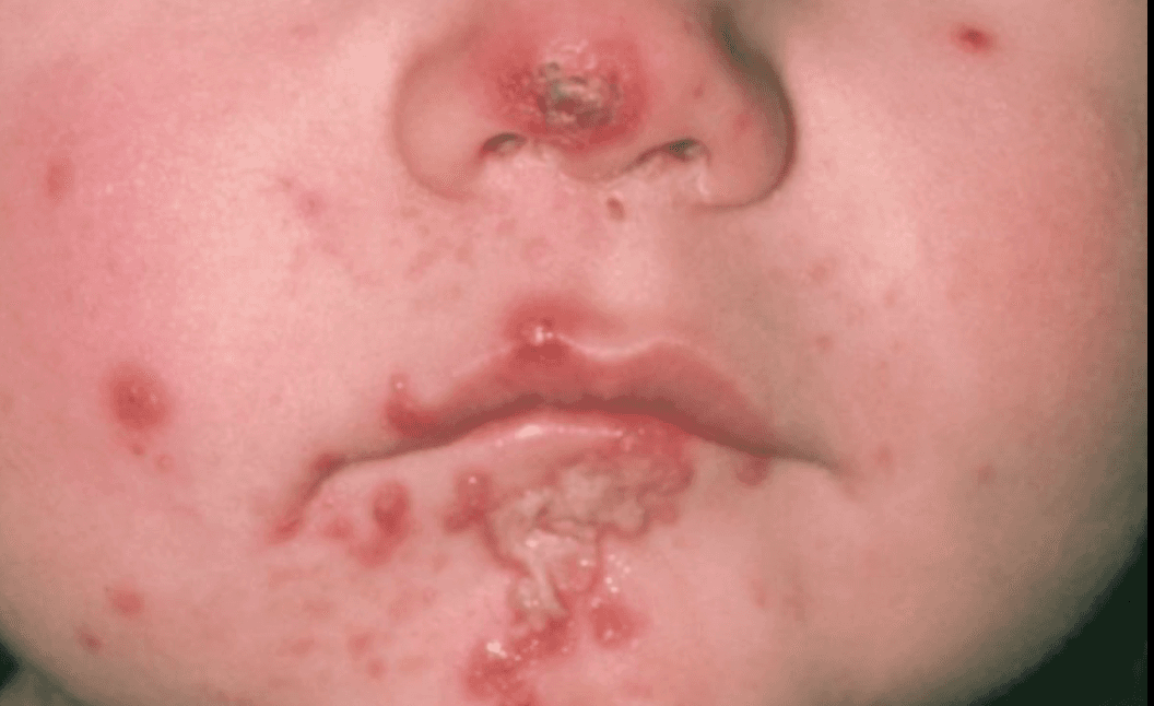 child with impetigo