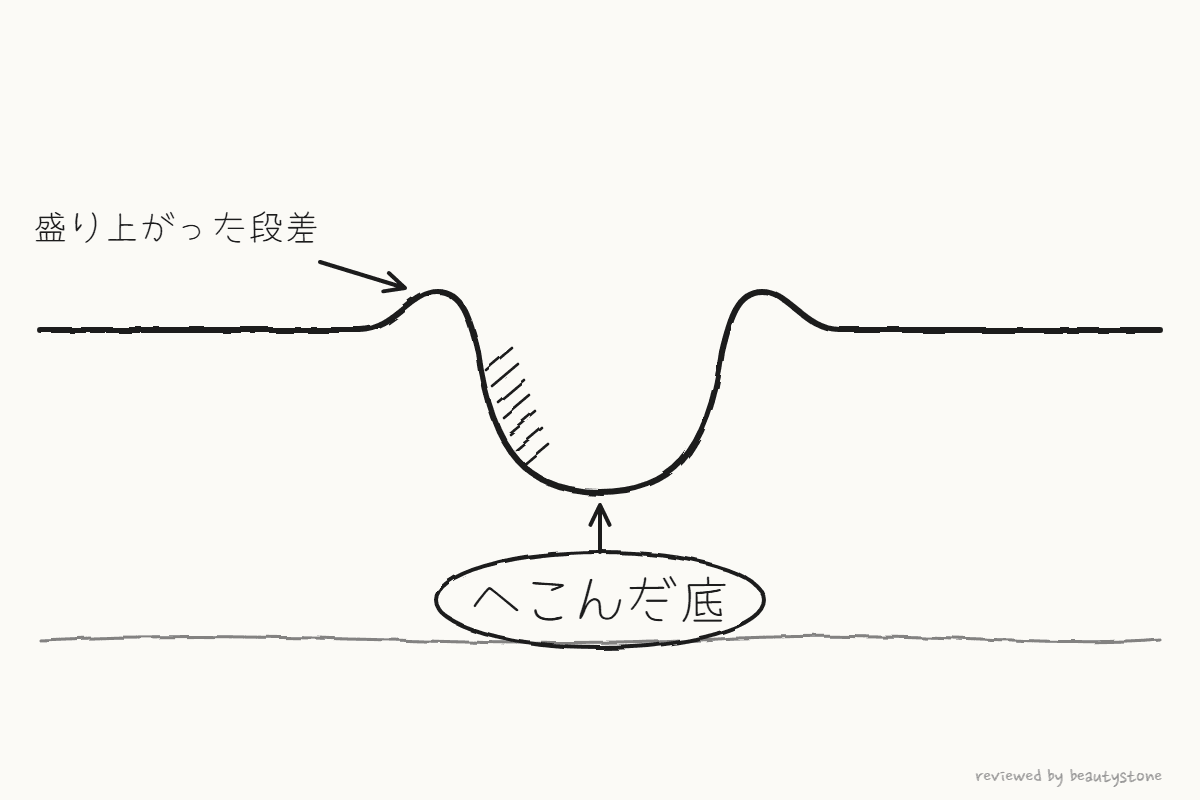 底がへこんだ傷跡の断面をペンで描いた図