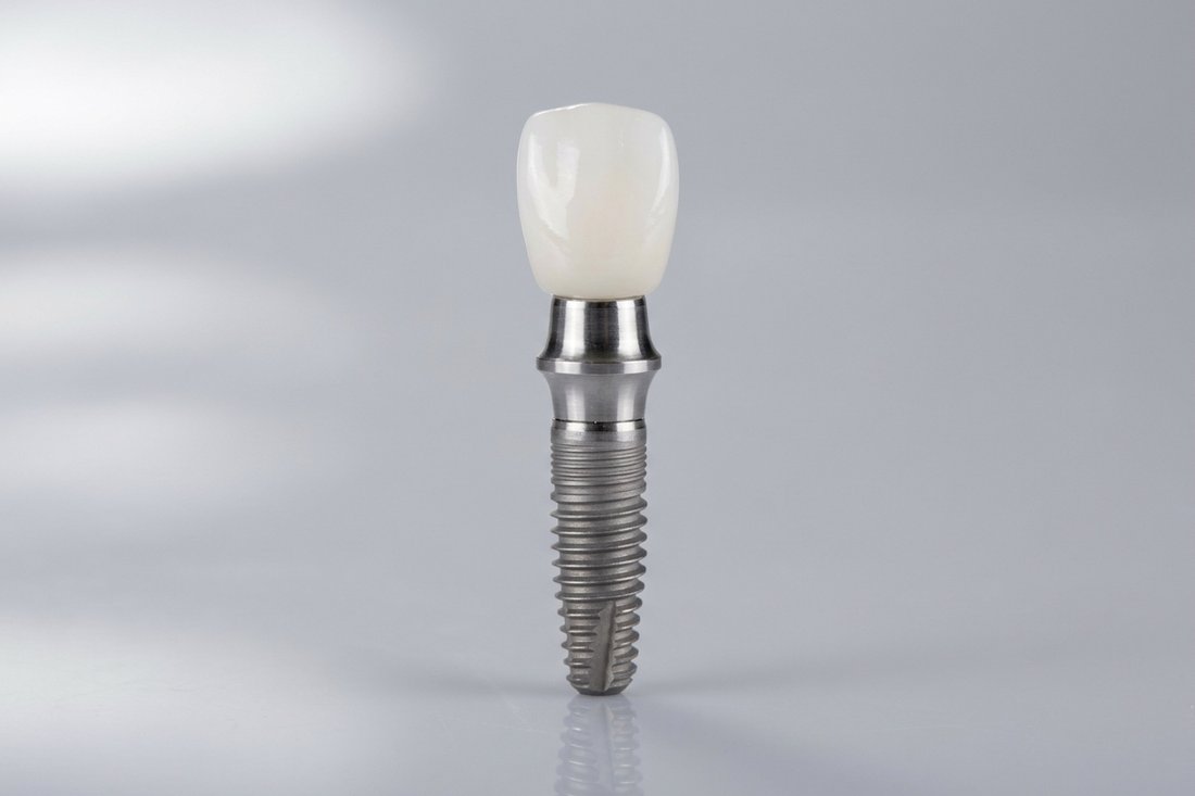 Dental implant model showing the titanium post, abutment, and ceramic crown