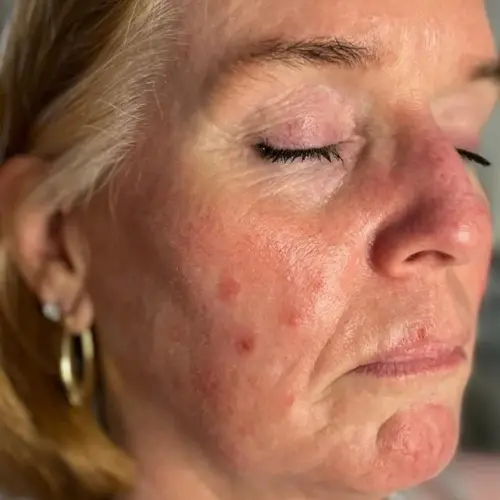 Before lymphatic drainage facial at The Vancouver Aesthetician — mature skin showing rosacea, slow healing, irritation and puffiness associated with sluggish lymphatic drainage