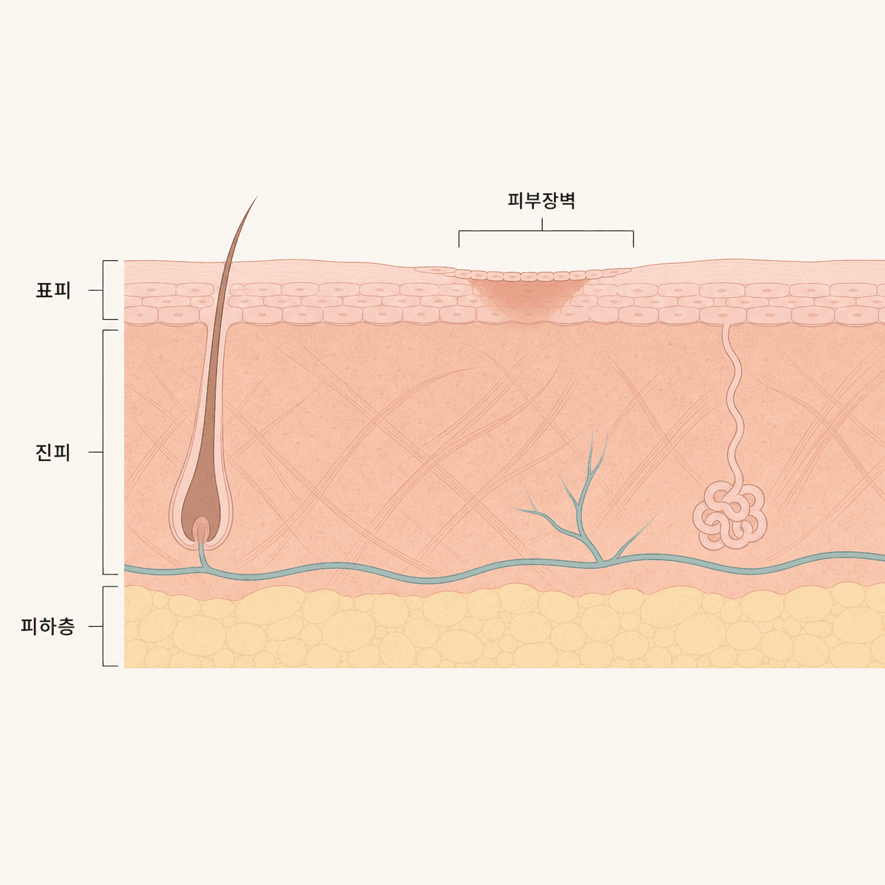 표피·진피·피하층과 회복 중인 피부 장벽