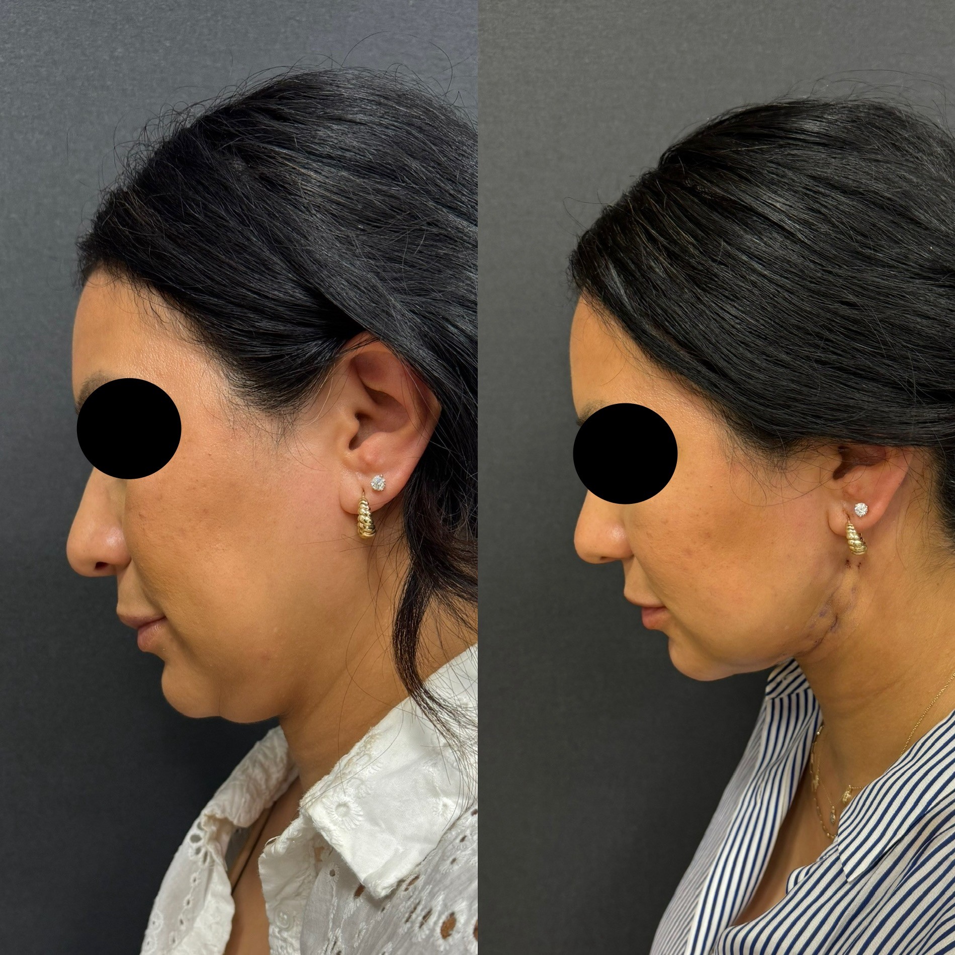 double chin liposuction with thread lift 2 days post-op before after left side view