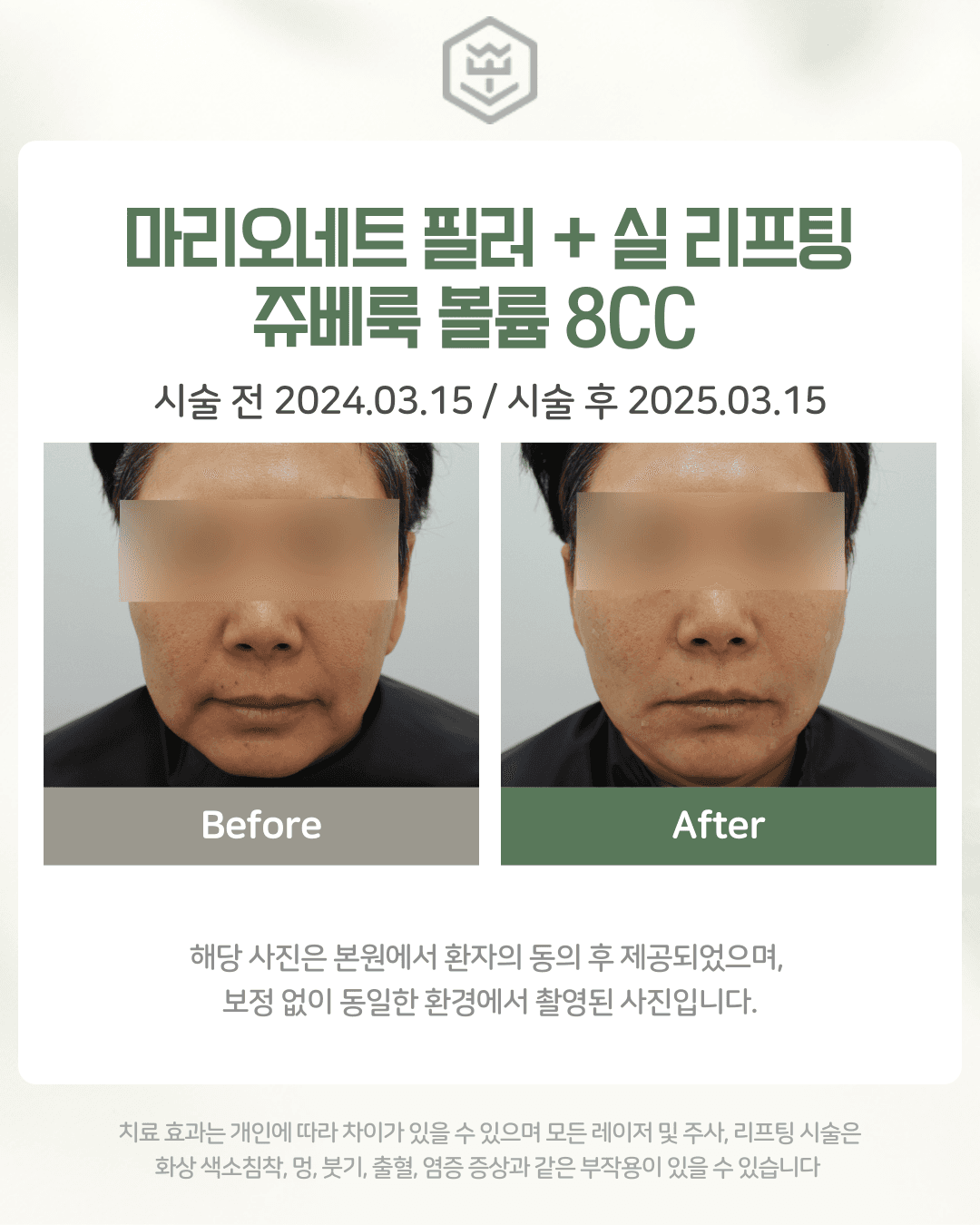 마리오네트 필러+실리프팅+쥬베룩볼룸