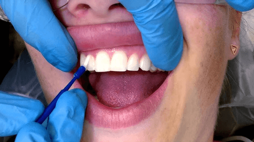 fluoride treatment