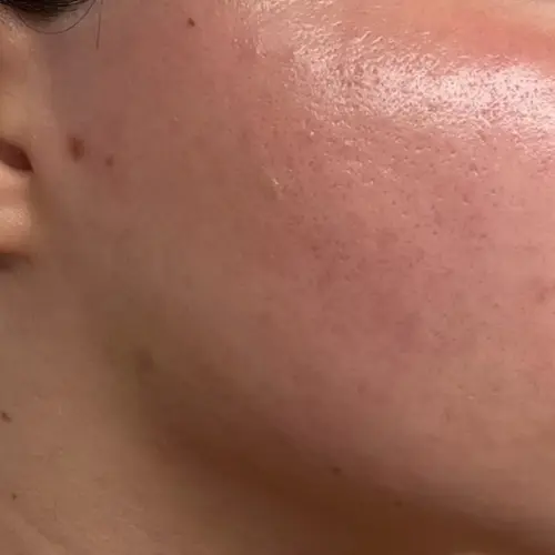 After dermaplaning facial hair removal at The Vancouver Aesthetician — jawline and chin hair completely removed for smooth defined ski