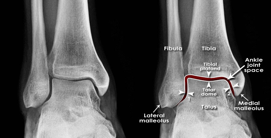 Ankle Ligament Reconstruction x-ray