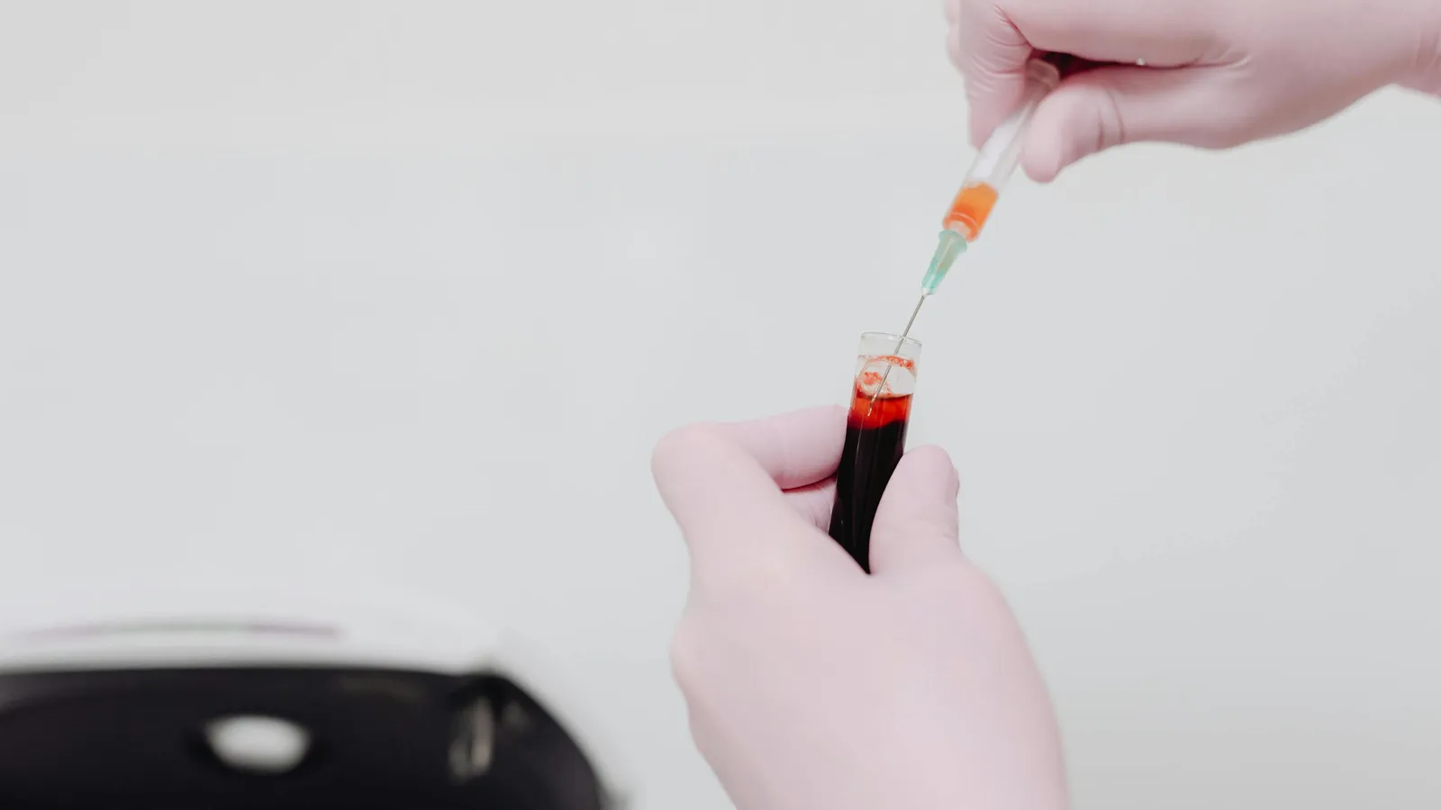 What Is the Normal Range for Urobilinogen in Urine?