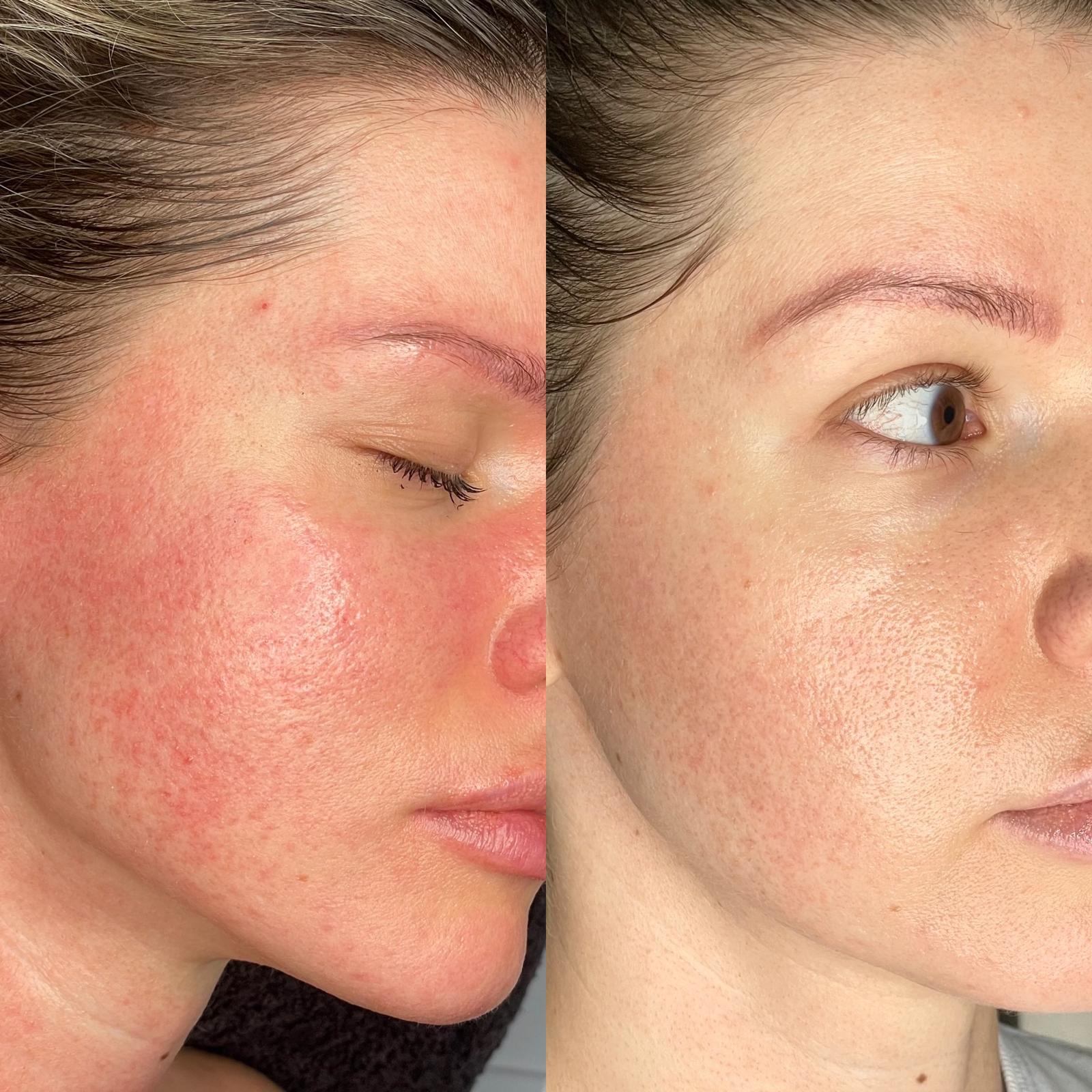 IPL Photorejuvenation amirova