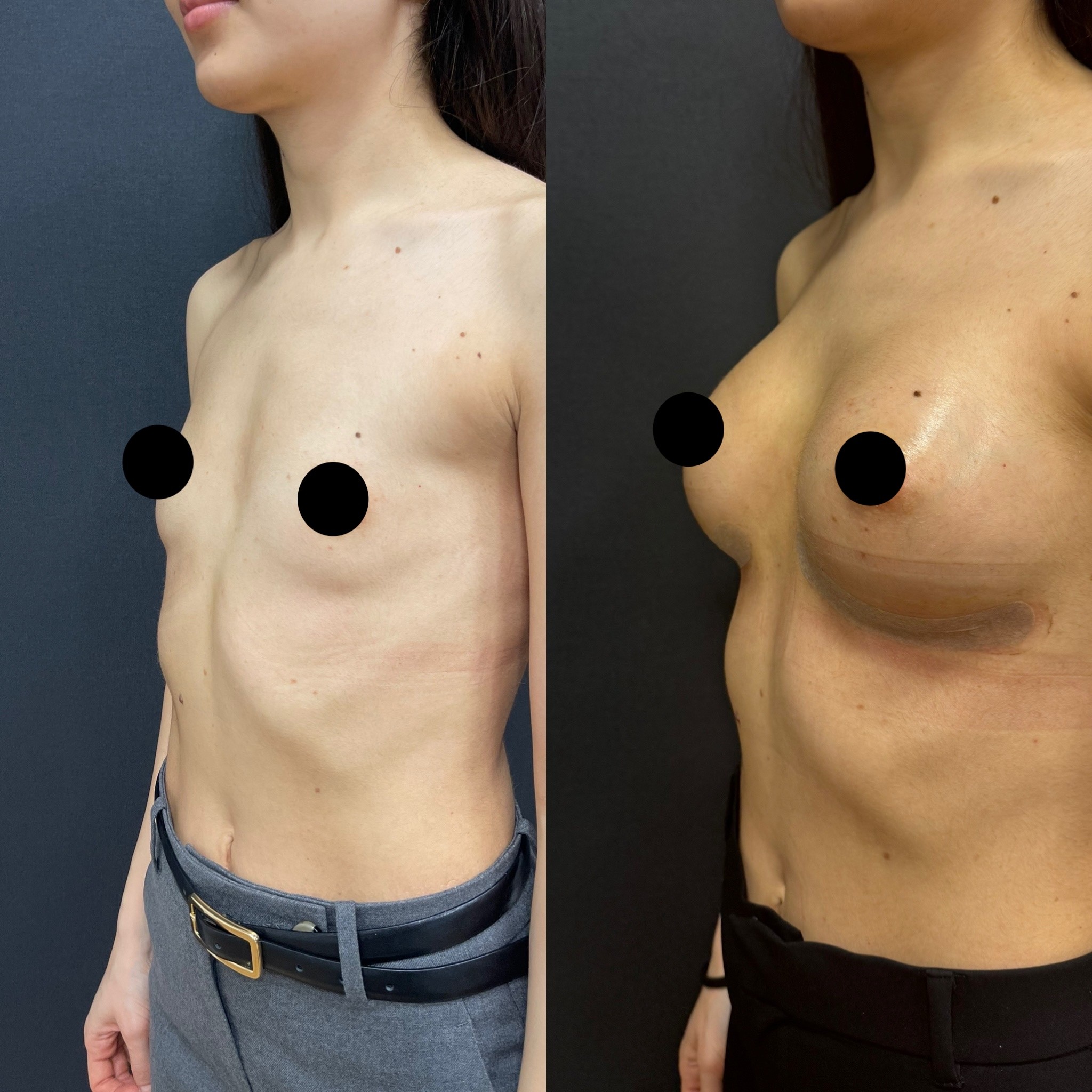 10 days breast augmentation result left oblique view