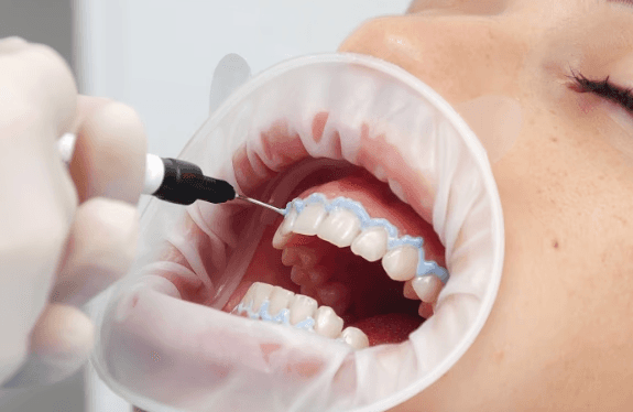 teeth whitening in Smyrna