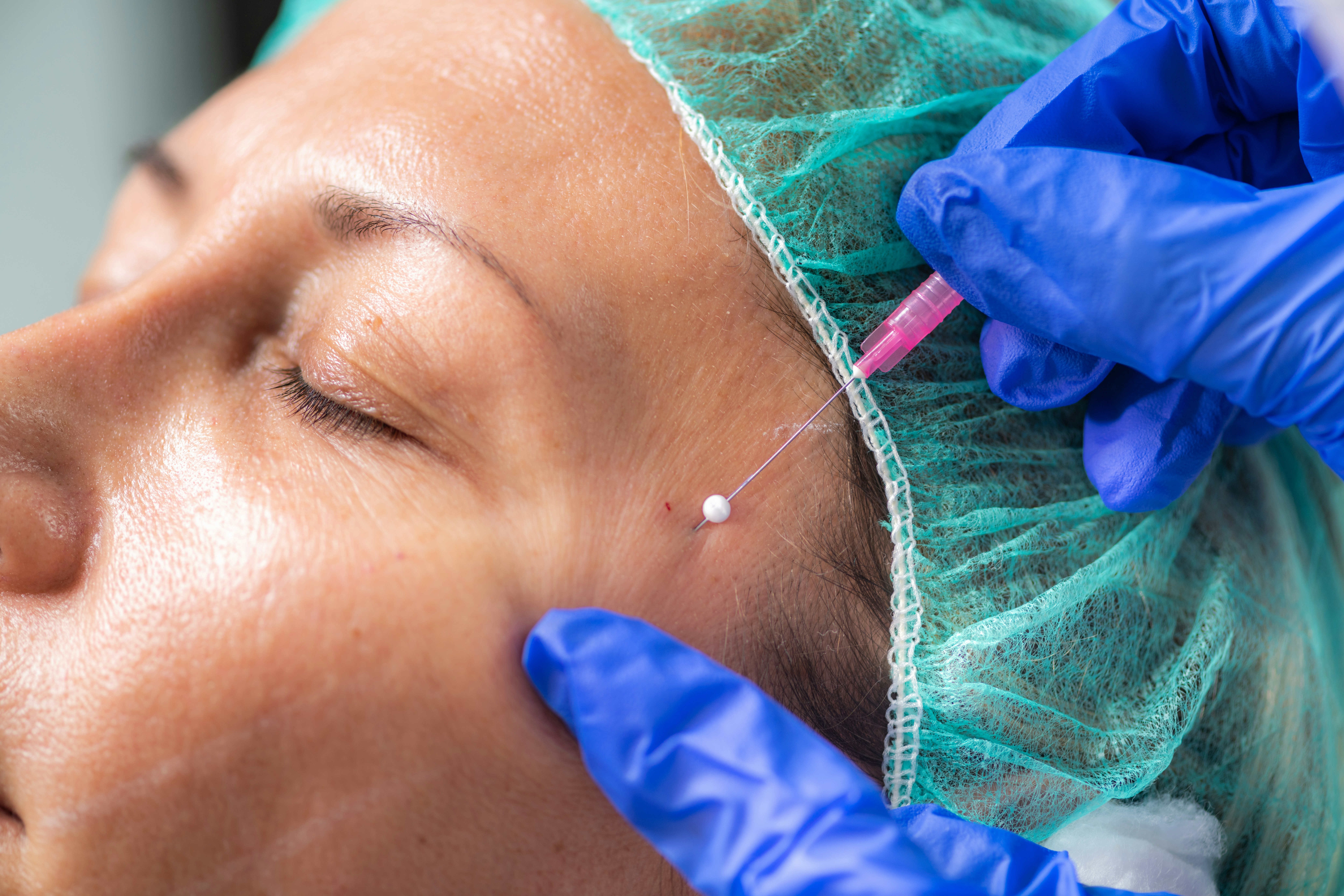 A provider injecting a small dose into a client’s forehead