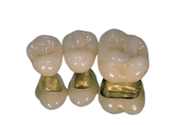 Fixed Restorations
