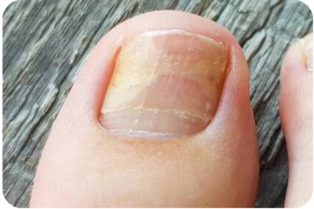 Mild discoloration (1 nail)