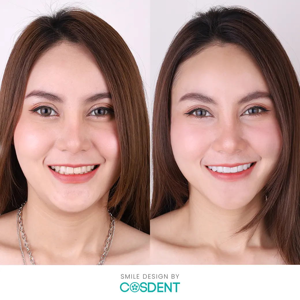 เมย์ รีวิวเคส หมอแจน cosdent smile design