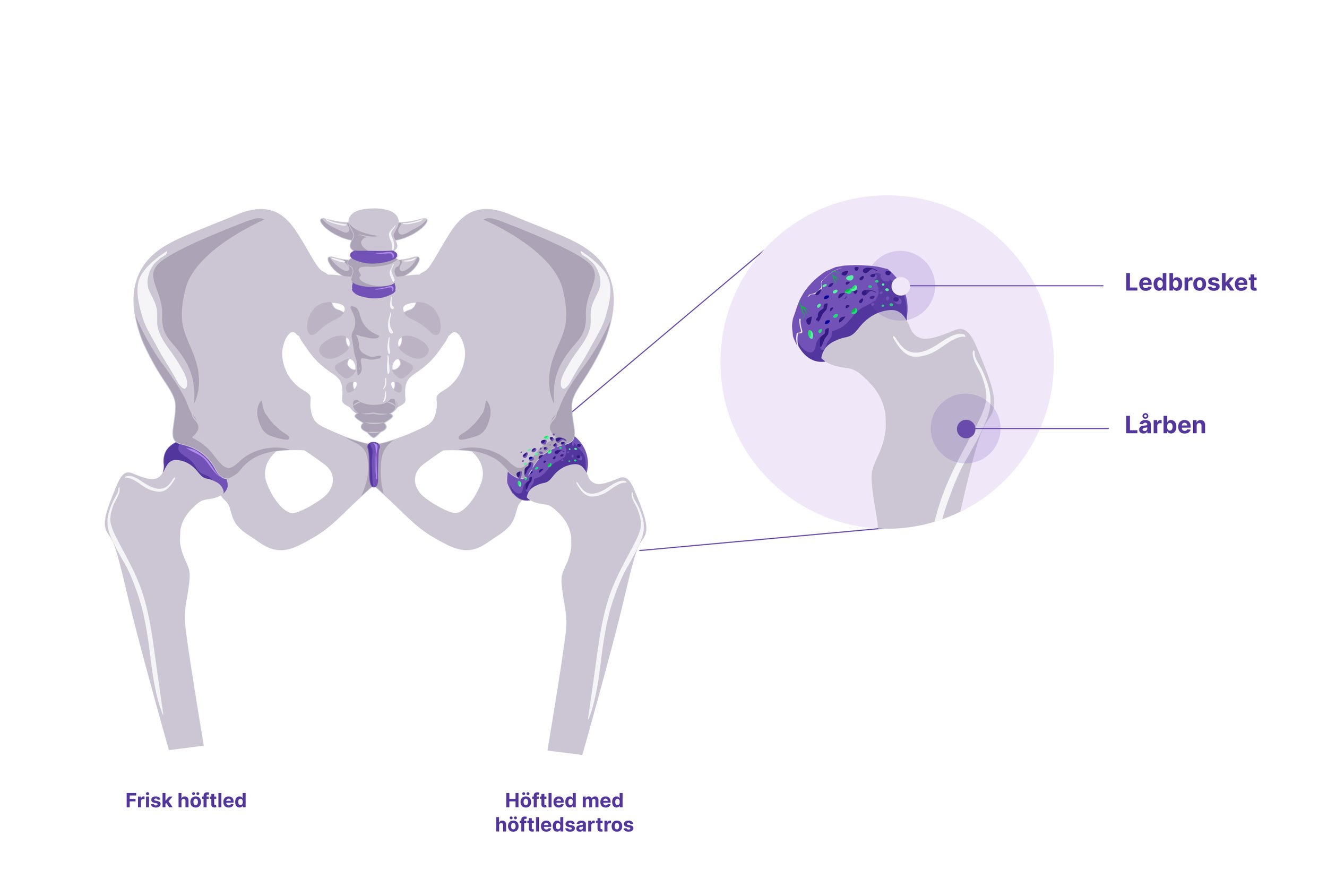 Illustration av höftledsartros