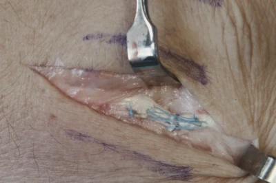 Extensor tendon repair in the hand area