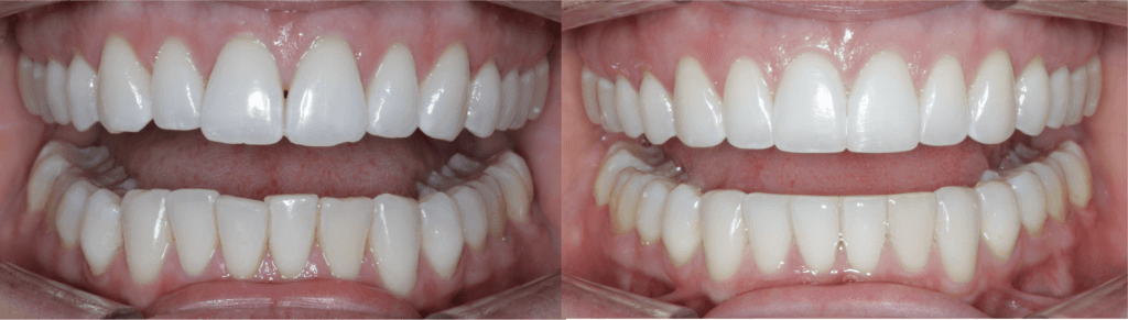 Enamel contouring and shaping