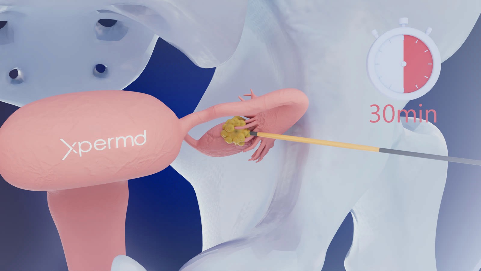 Animation 3D de l’embolisation d’un fibrome utérin