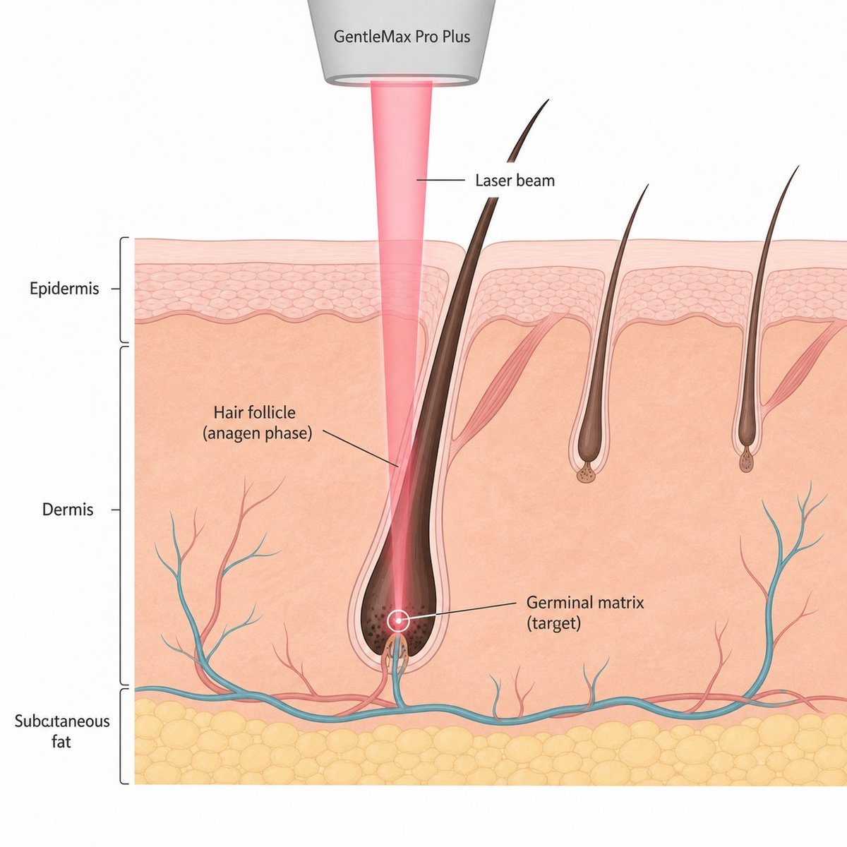 Diagram showing how GentleMax laser targets an active hair follicle while resting follicles remain unaffected