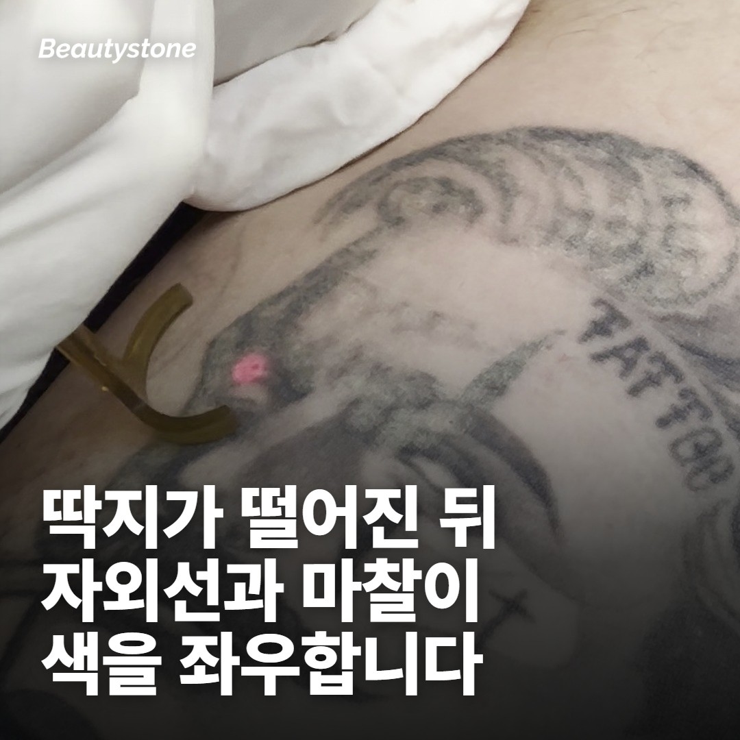 딱지가 떨어진 뒤가 회복의 후반입니다