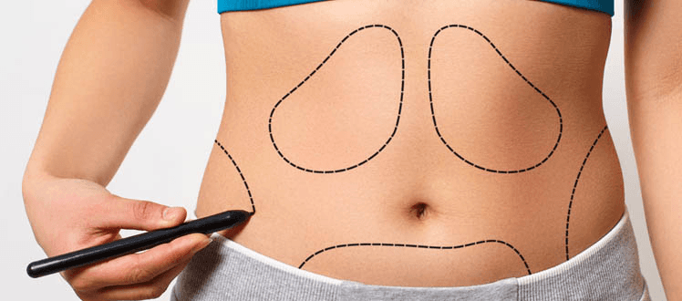 Liposuction vs Liposculpture: What’s the Real Difference?