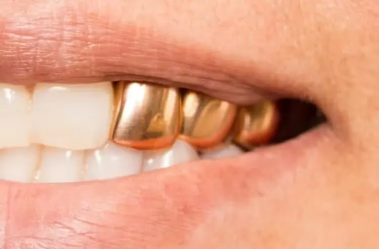 gold dental crown