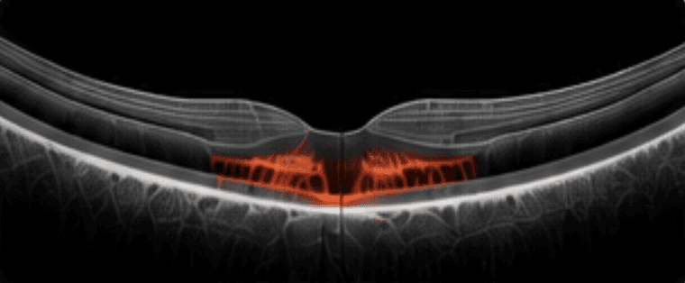 chronic central serous chorioretinopathy
