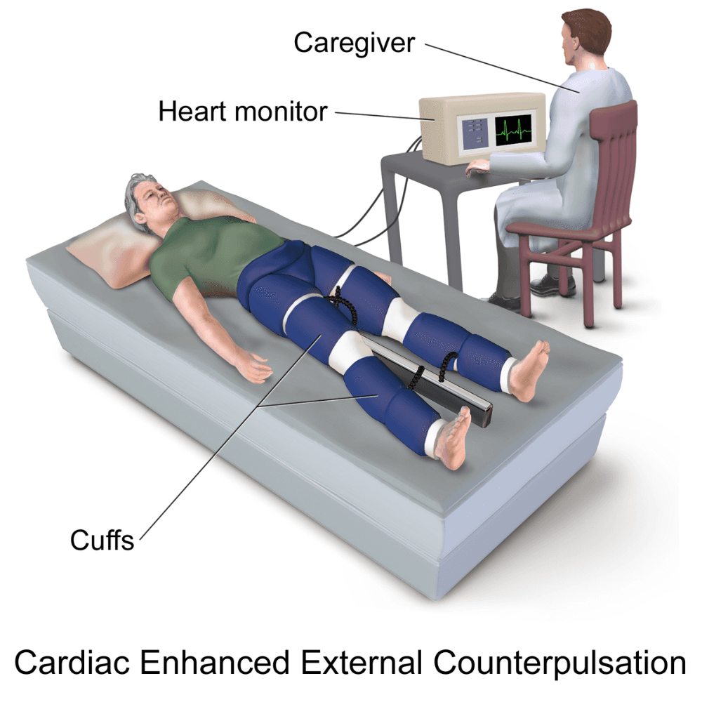 Illustration of a patient undergoing Enhanced External Counterpulsation (EECP) therapy, showing inflatable cuffs placed on the legs to improve blood flow, connected to a heart monitor operated by a caregiver. This visual explains the non-invasive procedure used to treat angina and heart failure.