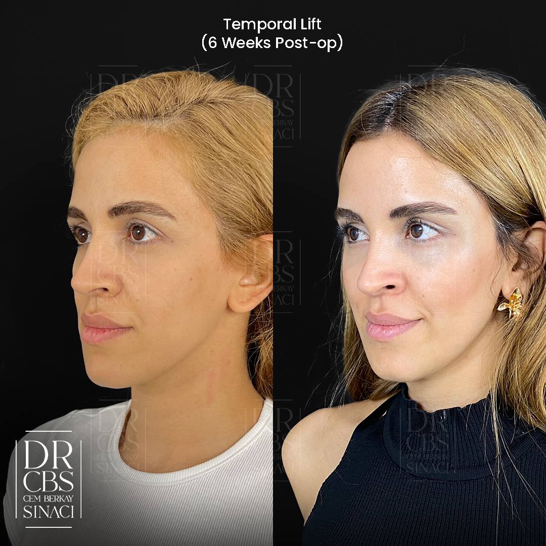 6 weeks post-op before after temporal lift - browlift and midfacelift oblique view