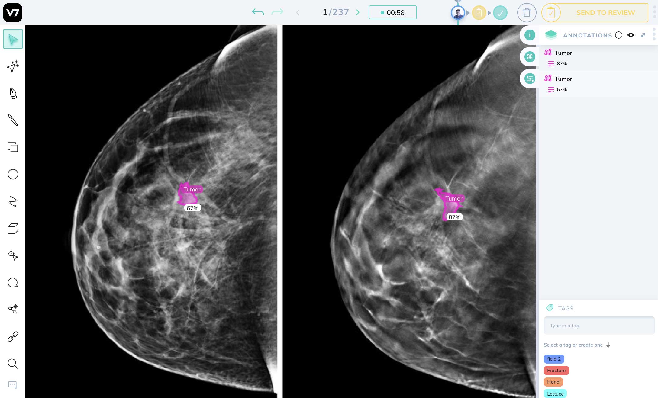 mammography detection AI in DICOM image annotation