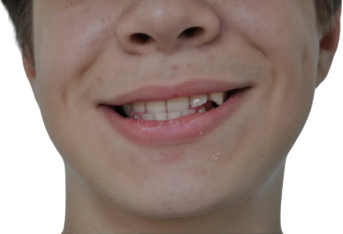  Cambiamenti positivi nel carattere accompagnati da una maggiore fiducia in se stessi. Riequilibrio del sorriso e della simmetria cranica e facciale