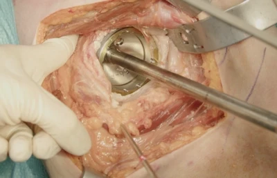 Total hip arthroplasty (uncemented) - posterior approach