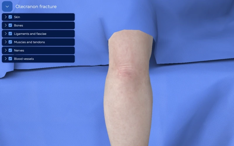 Olecranon fracture - tension band